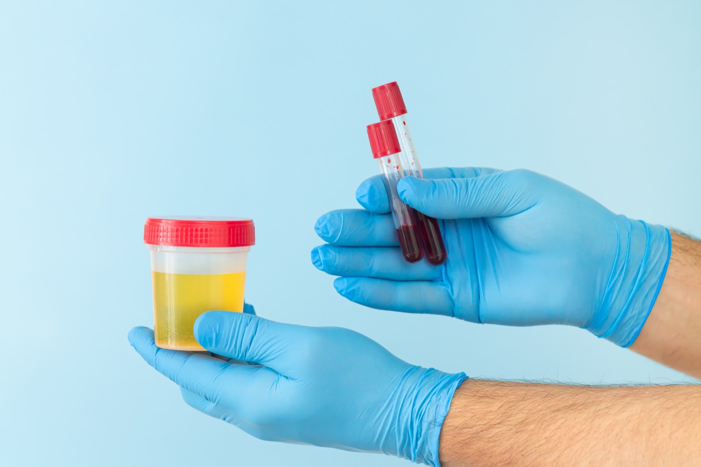 Blood in Urine (Haematuria)
