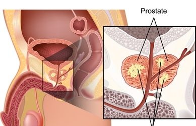 Diet and Other Main Considerations for Preventing Prostate Cancer