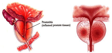 prostatitis a mandulagyulladás miatt