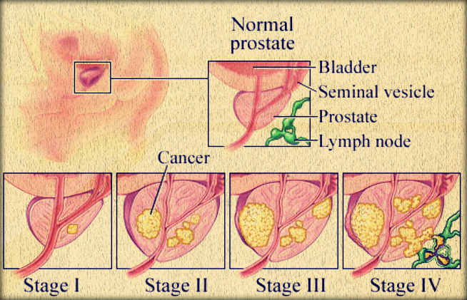 Types of Prostate Cancer