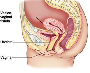 Urinary Tract Fistulae