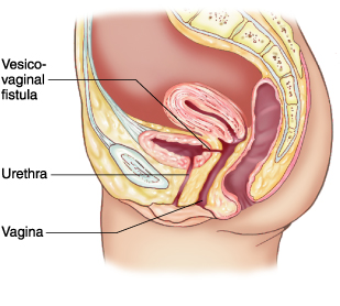 Urinary Tract Fistulae