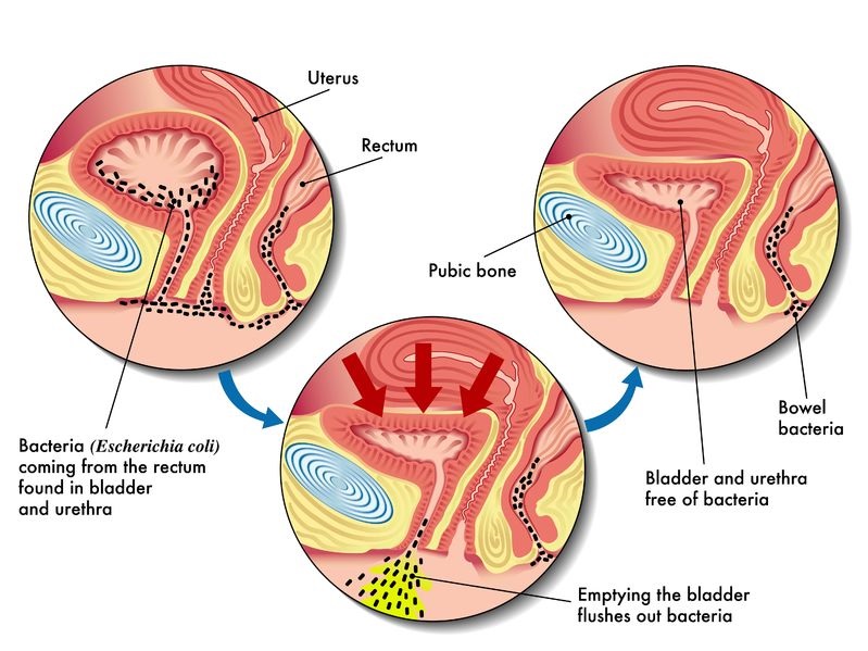 The Brief Information About Urinary Tract Infections