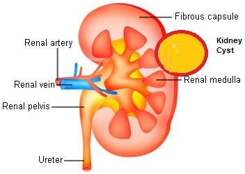 Simple Renal Cysts